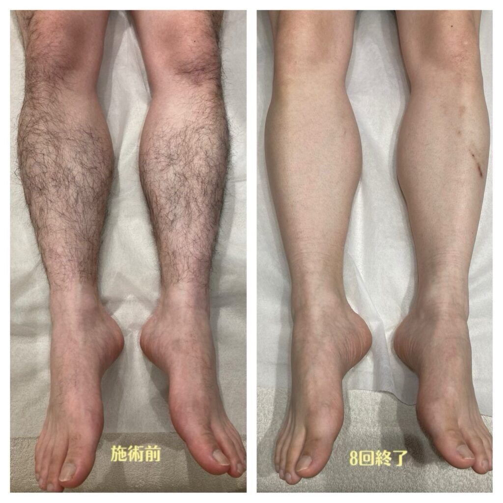 メンズ足脱毛の施術前と8回終了後のすね毛の状態を並べた比較写真