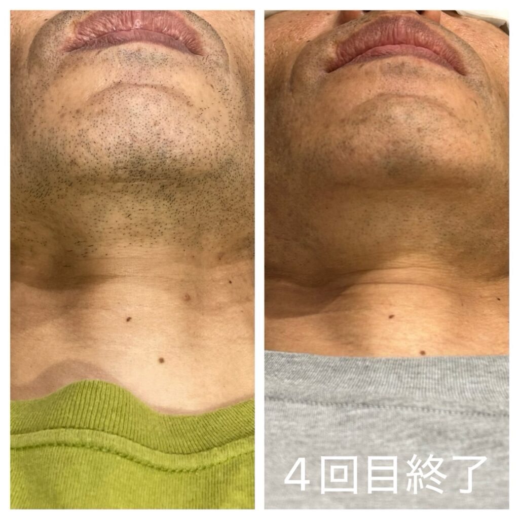 男性のあご下と首のヒゲ脱毛施術前と4回目終了後の状態を並べた比較写真